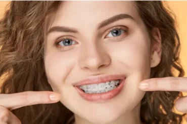 Ceramic Braces