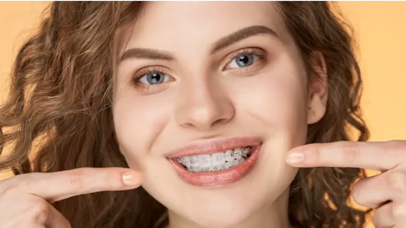 Ceramic Braces